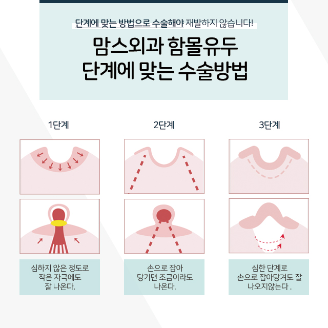 함몰유두교정 이젠걱정그만 관련 이미지 3