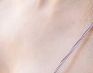 Nipple Reduction Surgery: If You Want a Perfect Breast Balance image 17