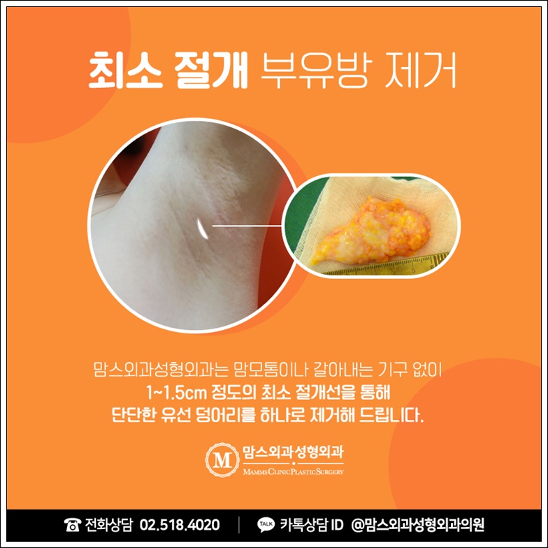 부유방제거비용 중요하지만 관련 이미지 6