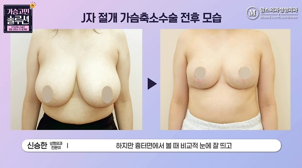 Looking at the J-Shaped Incision Method for Breast Reduction with Photos! image 14