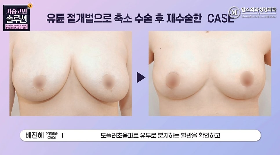 유륜절개 가슴축소 수술 후 수직절개 재수술, 가능할까? 관련 이미지 5