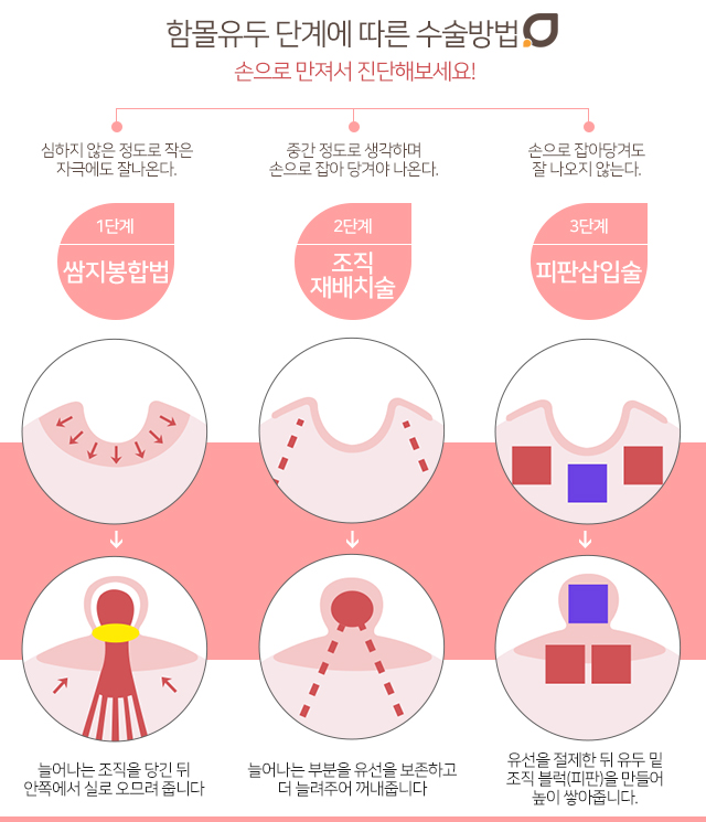 함몰유두교정 모유수유까지 관련 이미지 3