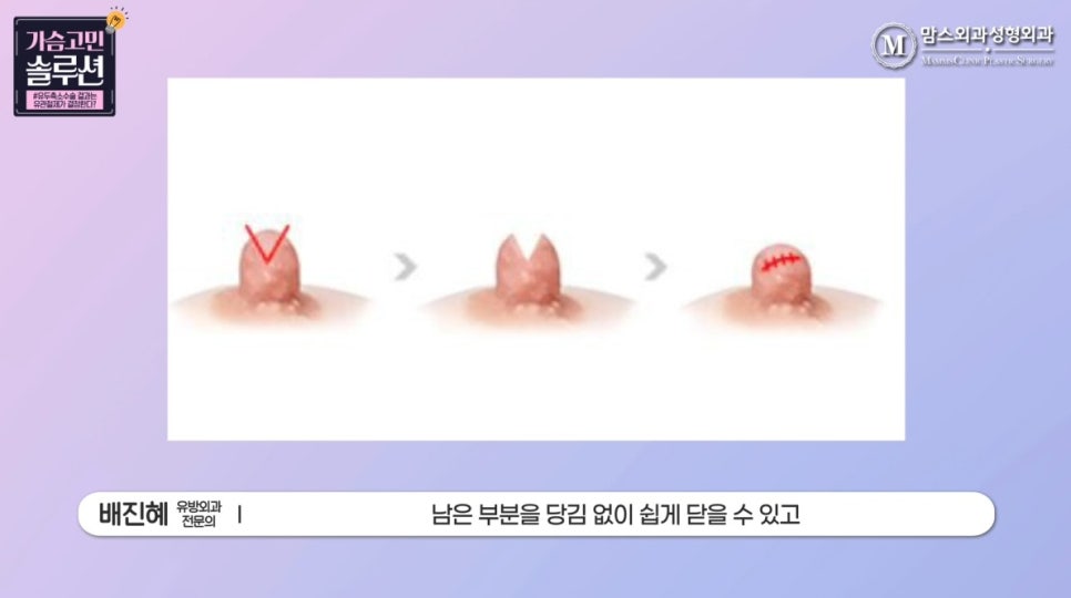 유두축소 수술, 유방외과 전문의가 말하는 결과를 결정하는 ‘이것’은? 관련 이미지 11
