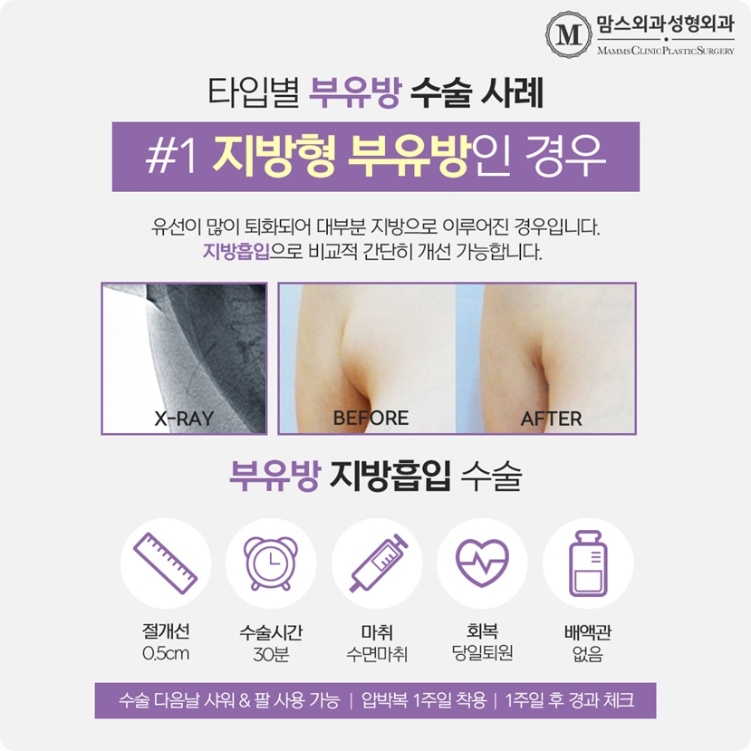Axillary accessory breast tissue removal — does it differ case by case? image 7