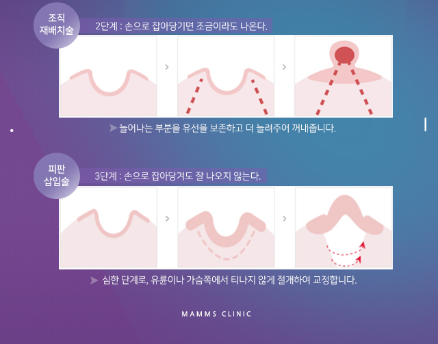 유두함몰 걱정없이 관련 이미지 6