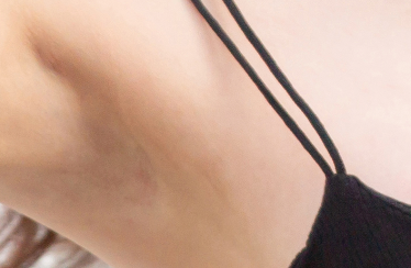 겨드랑이지방흡입 부유방제거는 병원과 전문의 선택이 정말 중요합니다 관련 이미지 18