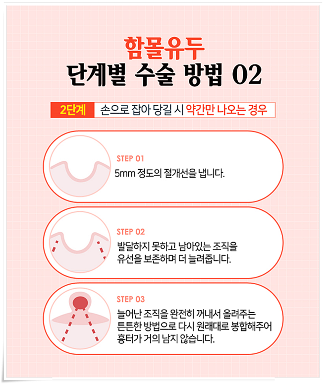 함몰유두 원인 아직까지 몰랐었지 관련 이미지 7
