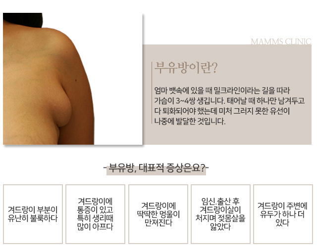 부유방제거수술 한번에깔끔하게 관련 이미지 2
