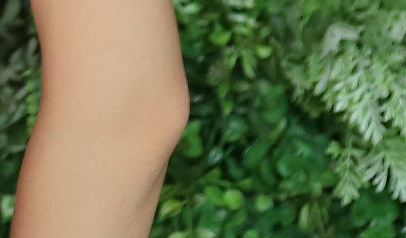 부유방통증 원인을 제대로 파악한 맞춤형 수술로 개선하세요! 관련 이미지 24