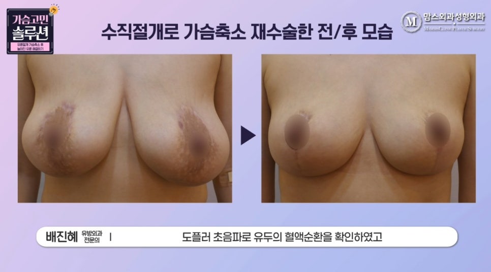 가슴축소재수술 실제 사례, 늘어진 유륜 개선하기! 관련 이미지 6