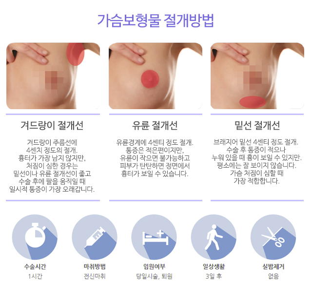 물방울가슴성형후기 여자를잘아는곳에서 관련 이미지 3