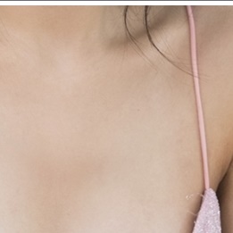 Breast Reduction Surgery from a Different Perspective image 17