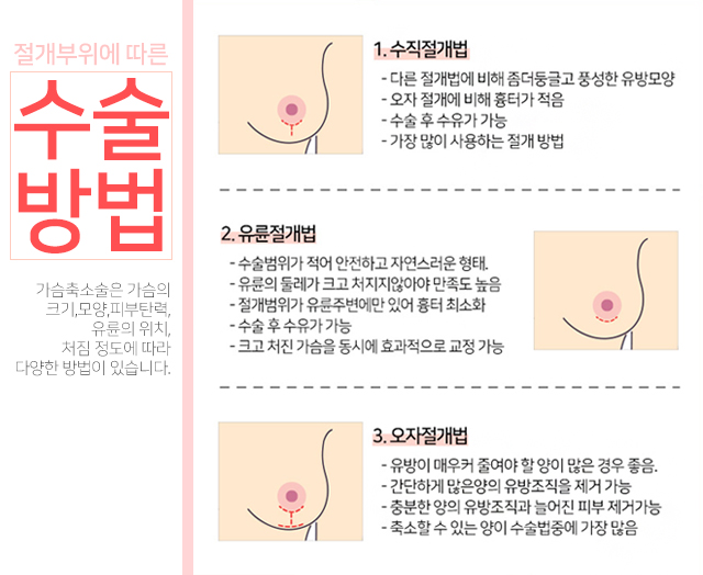 가슴축소술 자신있는나로! 관련 이미지 4