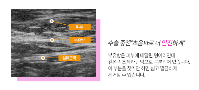 부유방제거수술 한번에해결 관련 이미지 5