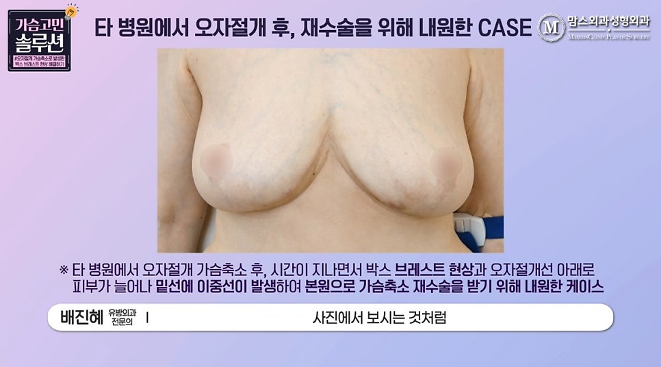 Can breast reduction revision surgery be done with a vertical incision after an inverted-T incision? image 3