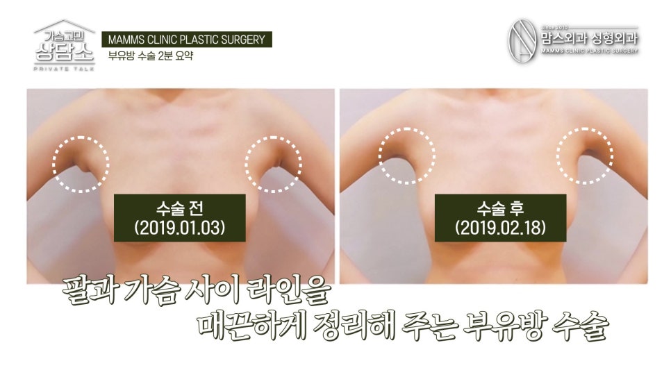 Accessory Breast Removal Surgery: Is Fat Removal Enough? What Is the Standard for Gland Excision? image 3