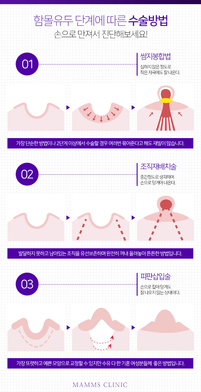 함몰유두수술 단계별로 관련 이미지 5