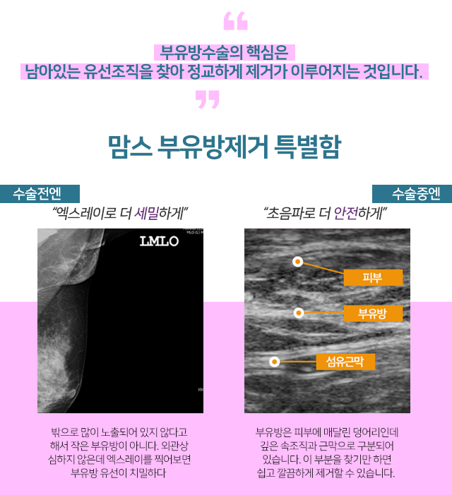 부유방수술후기 깔끔하게 관련 이미지 3