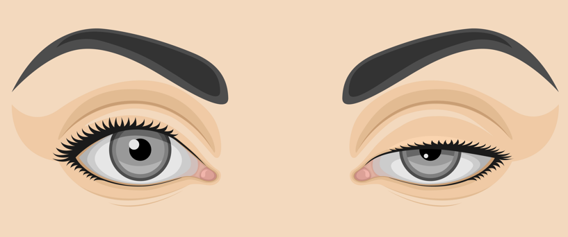 If You're 고민ing Between Incisional and Non-Incisional Mid-Age Eye Correction, Be Sure to Read This image 4