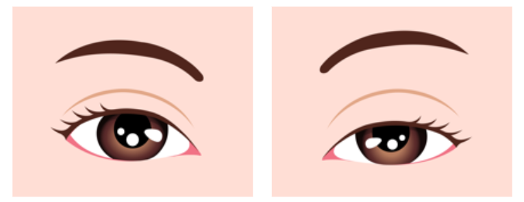 Upper Eyelid Surgery Price? Side Effects? Click If You’re Worried image 5