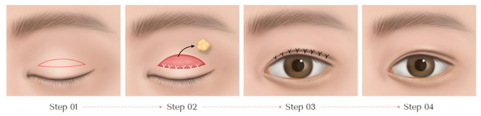 Read This First if You Want to Avoid Double Eyelid Revision Surgery at Jamsil Station Plastic Surgery Clinic <Written by a Doctor> image 7