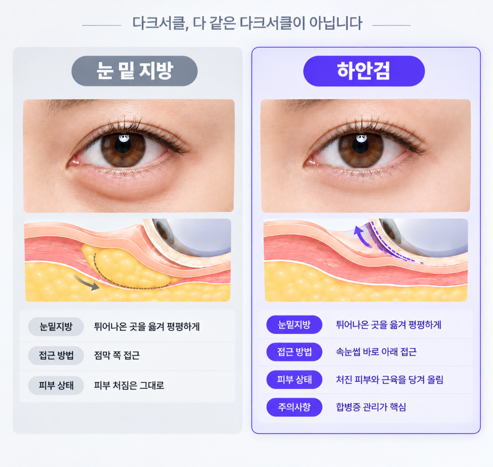 다크써클눈밑지 수술 전 가이드 | 피부유형별 눈밑지하안검 차이 비교 관련 이미지 3