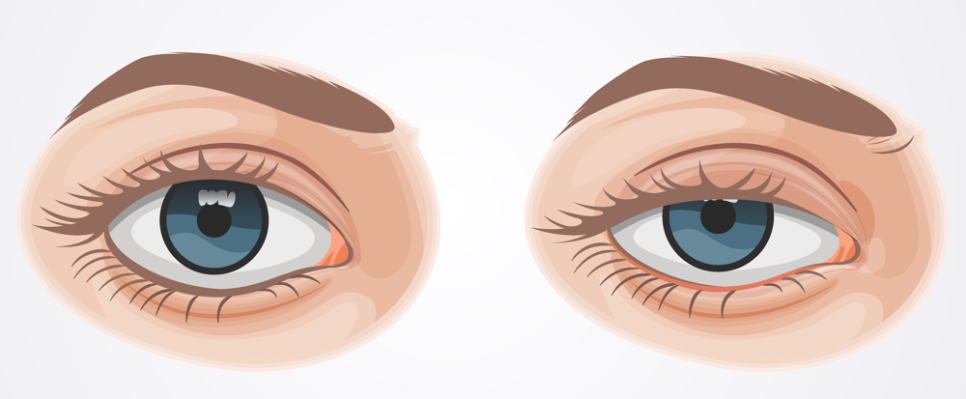 Songpa Plastic Surgery for Eye Surgery? Upper Eyelid or Lower Eyelid Surgery? Age Does Not Matter image 3