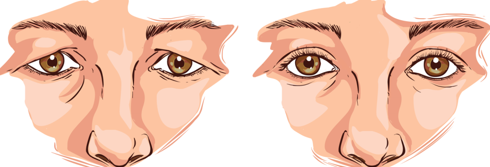 Does double eyelid surgery work in your 40s and 50s? A complete guide to recovery and side effects image 2