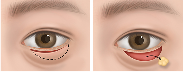 Konkuk University Upper Eyelid Surgery? Realistic Reasons You Should Also Consider Lower Eyelid Surgery - Piaf Clinic image 5