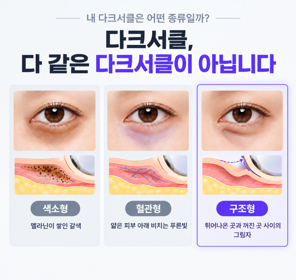 다크써클눈밑지 수술 전 가이드 | 피부유형별 눈밑지하안검 차이 비교 관련 이미지 2