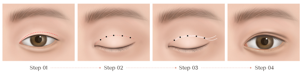 Read This First if You Want to Avoid Double Eyelid Revision Surgery at Jamsil Station Plastic Surgery Clinic <Written by a Doctor> image 6
