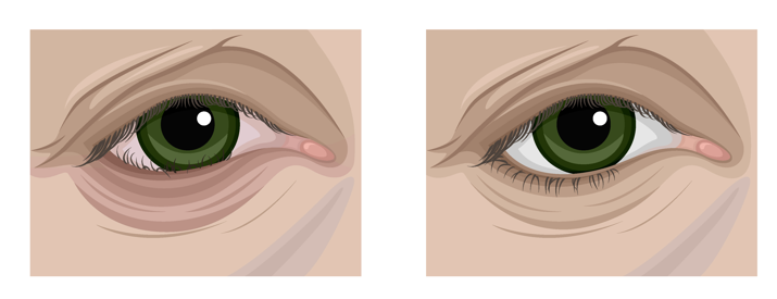 Songpa Plastic Surgery for Eye Surgery? Upper Eyelid or Lower Eyelid Surgery? Age Does Not Matter image 5