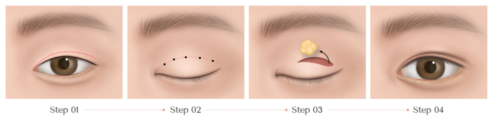 Read This First if You Want to Avoid Double Eyelid Revision Surgery at Jamsil Station Plastic Surgery Clinic <Written by a Doctor> image 8