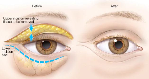 Lower Eyelid Surgery in Your 40s: There Is Another Reason It Fails image 2