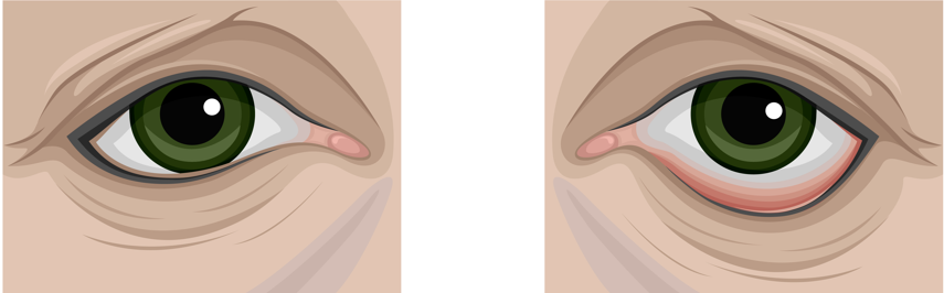 Jamshil Upper Eyelid Surgery vs. Lower Eyelid Surgery, Including Things to Check Before Surgery - Piap Clinic image 3