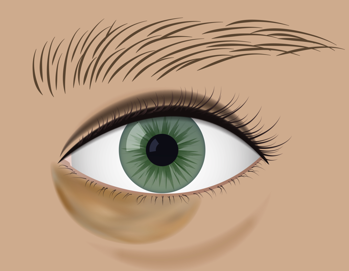 Jamshil Upper Eyelid Surgery vs. Lower Eyelid Surgery, Including Things to Check Before Surgery - Piap Clinic image 5