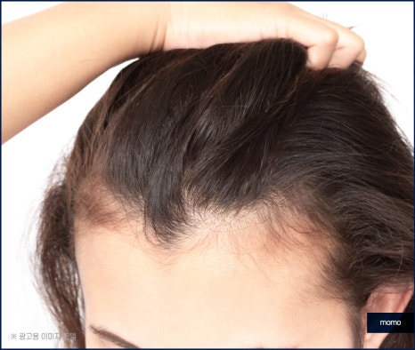 여자 m자 이마 헤어라인 모발이식으로 교정 관련 이미지 4