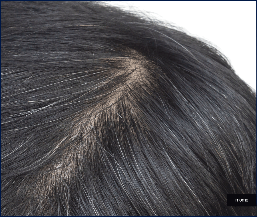 압구정 모발이식 병원 찾고 있다면 꼭 확인하세요 관련 이미지 7