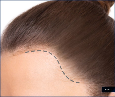 헤어라인 교정 비용 및 방법 디자인의 중요성 관련 이미지 3