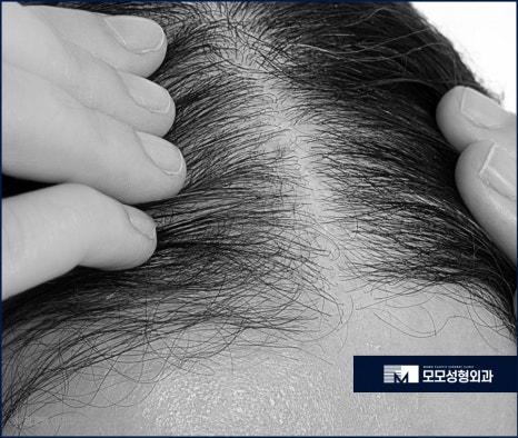 여자 옆머리 탈모 이유와 극복하고 채워가려면 관련 이미지 3