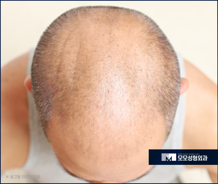 모발이식3000모비용 찾아 보는 것 보다 우선적인 것은 관련 이미지 3