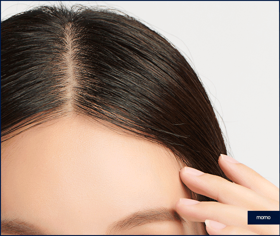 헤어라인 모발이식 비용보다 꼼꼼히 알아볼 조건은? 관련 이미지 4