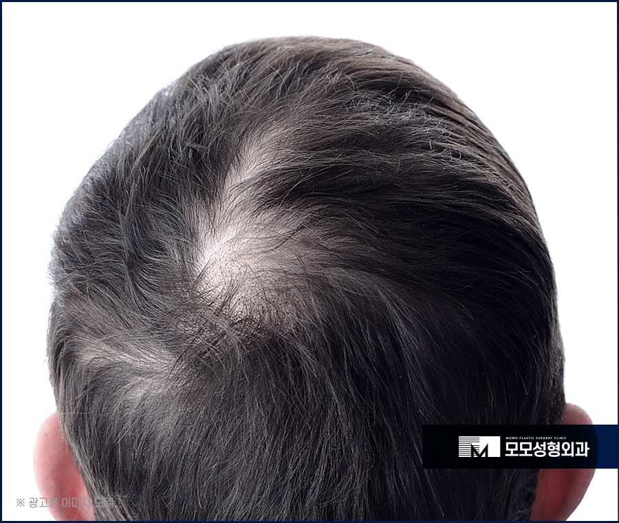 원형탈모치료병원 정교한 시술로 관련 이미지 5