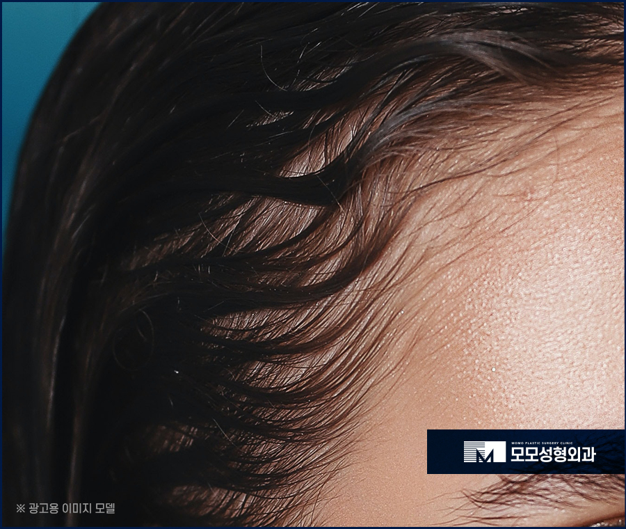 여성헤어라인모발이식 보강이 필요하다면 관련 이미지 11