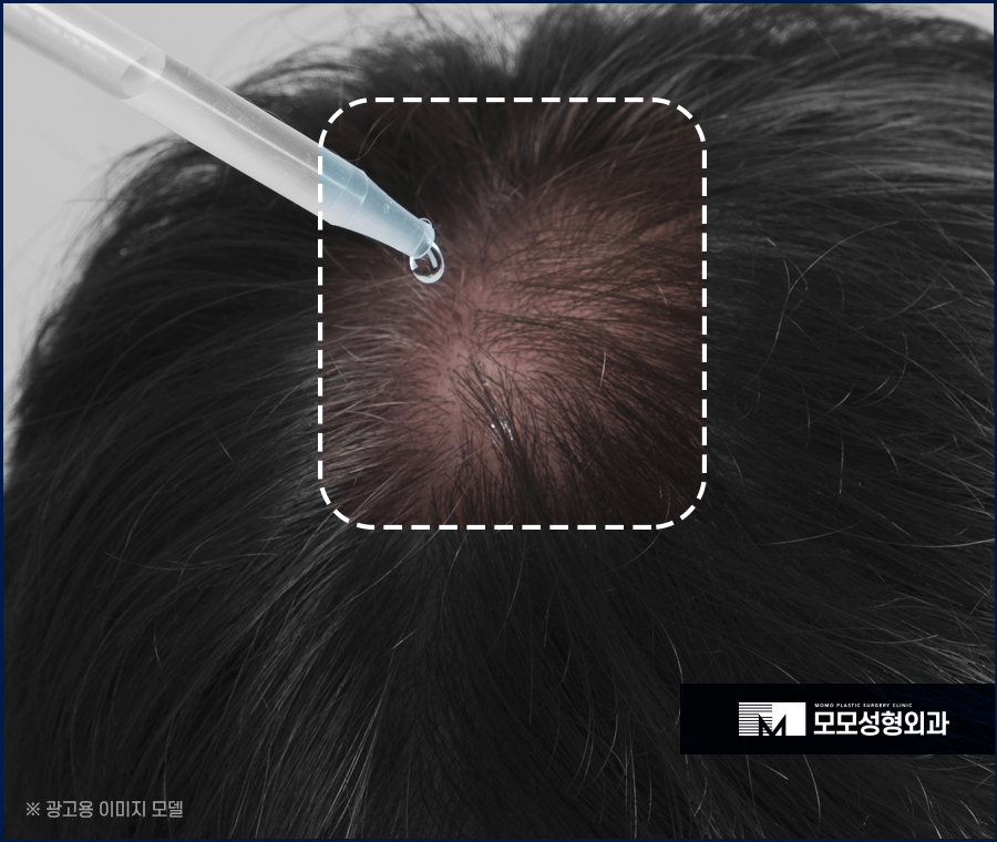 미녹시딜 5% 효과와 사용 전 알아두어야 할 점 관련 이미지 4