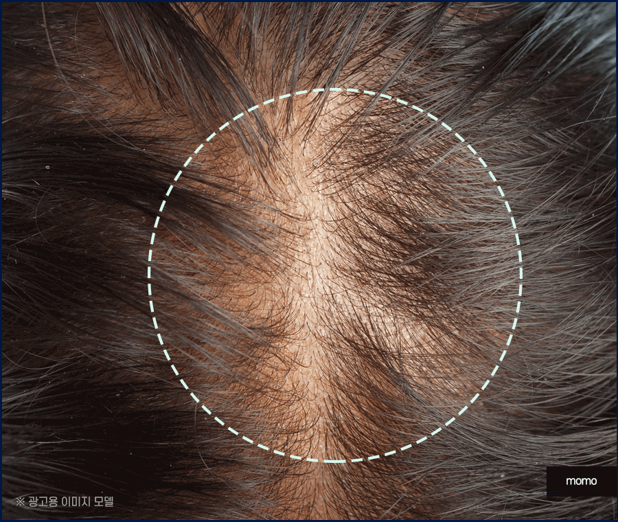 출산후 탈모 자연스럽게 보완하는 방법은 관련 이미지 10