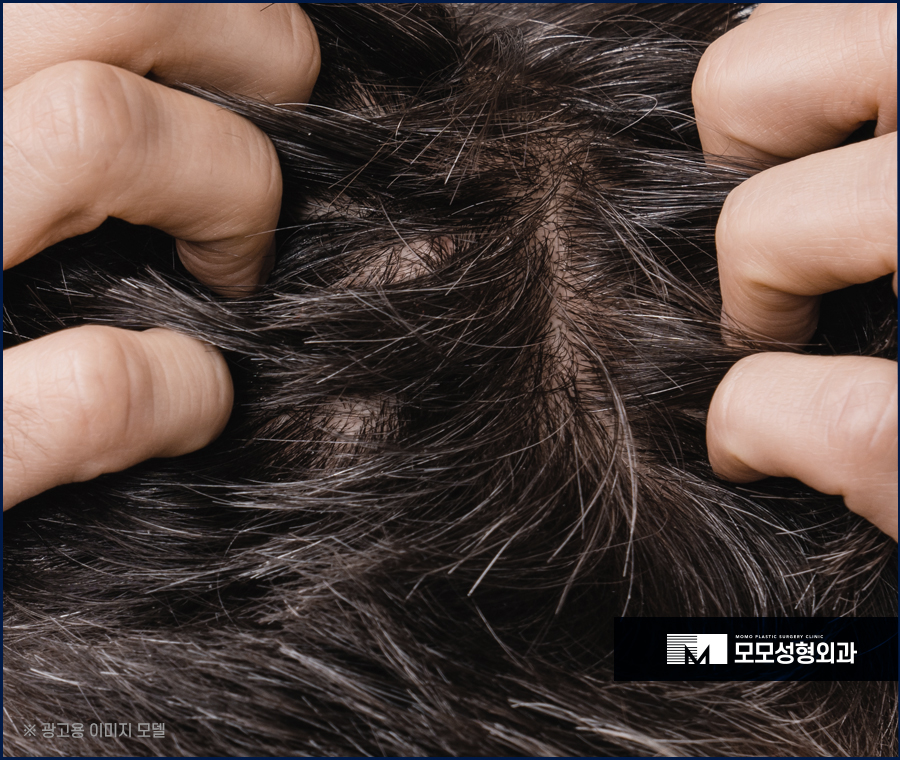 서울 모발이식 오랜 고민을 이겨내기 위한 선택 관련 이미지 2