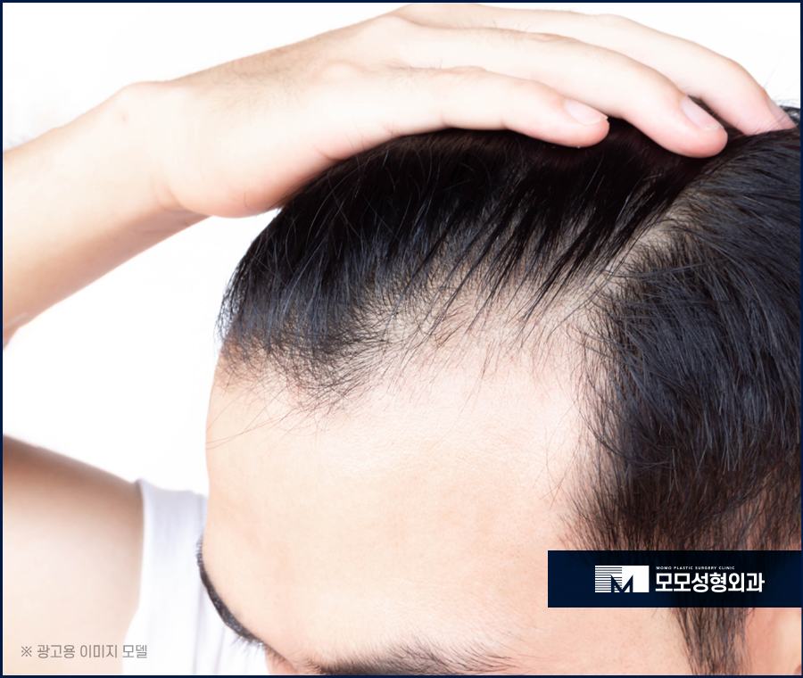 여성앞머리탈모 외모를 위해 보강해야 하는 관련 이미지 4