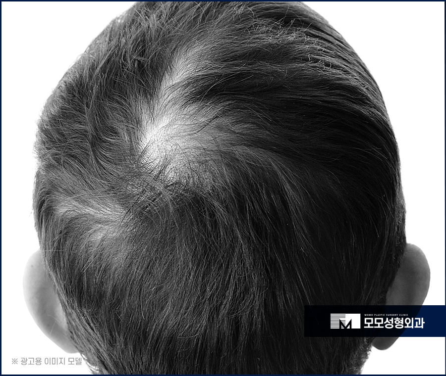 연예인모발이식 성공적인 변화를 위해서 관련 이미지 2