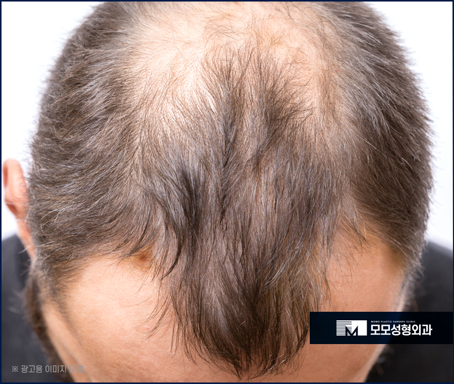 안드로겐성탈모 원인과 개선을 위한 방안은 관련 이미지 4